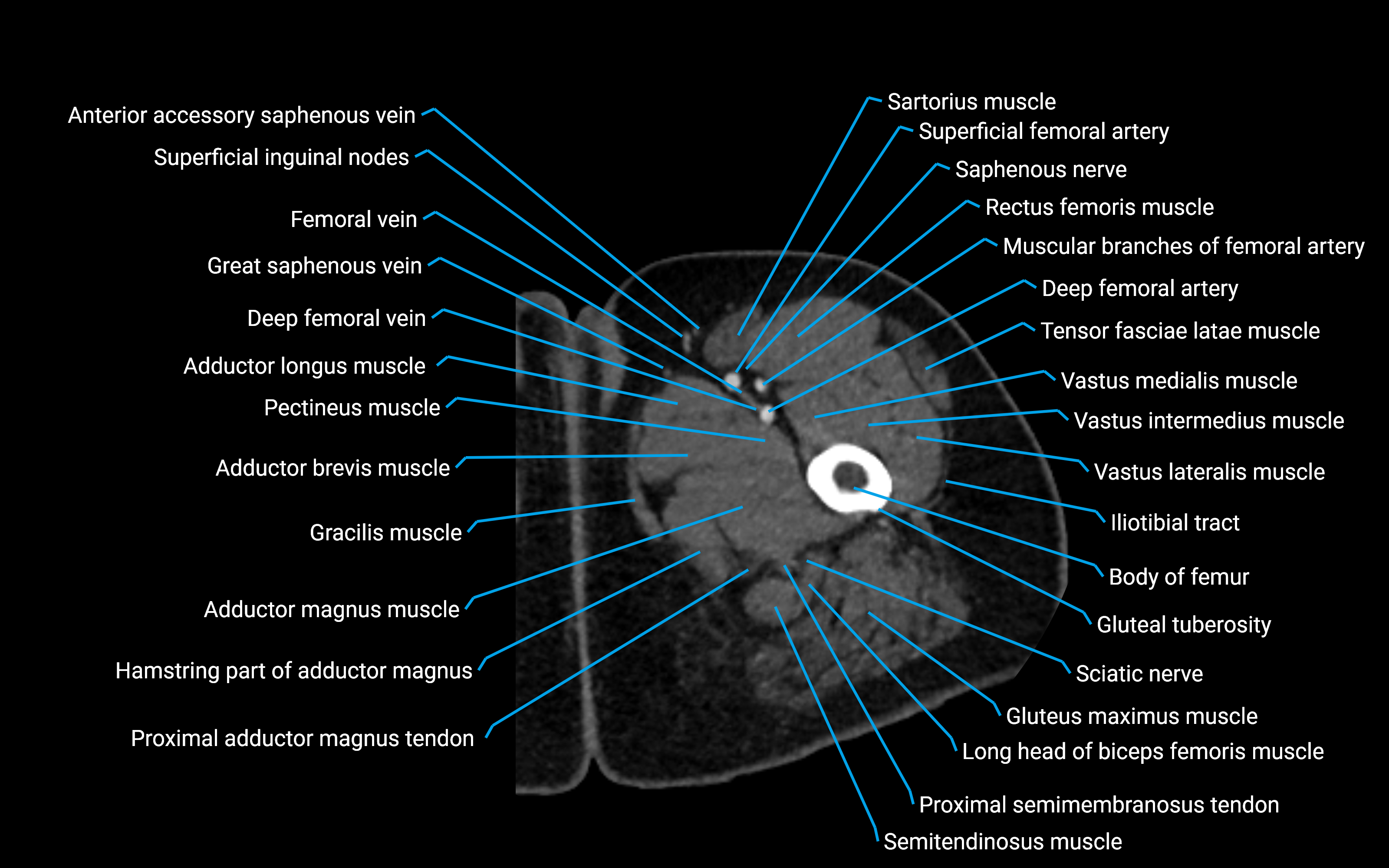 CT Hip axial cross sectional anatomy labelled image 23 (2).png